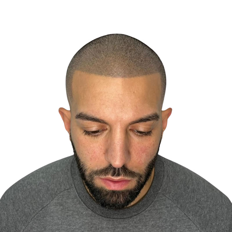 Scalp Micropigmentation SMP Rayleigh Essex Scalp Micropigmentation SMP Rayleigh Essex