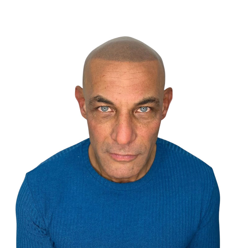 Scalp Micropigmentation SMP Rayleigh Essex 2 Scalp Micropigmentation SMP Rayleigh Essex