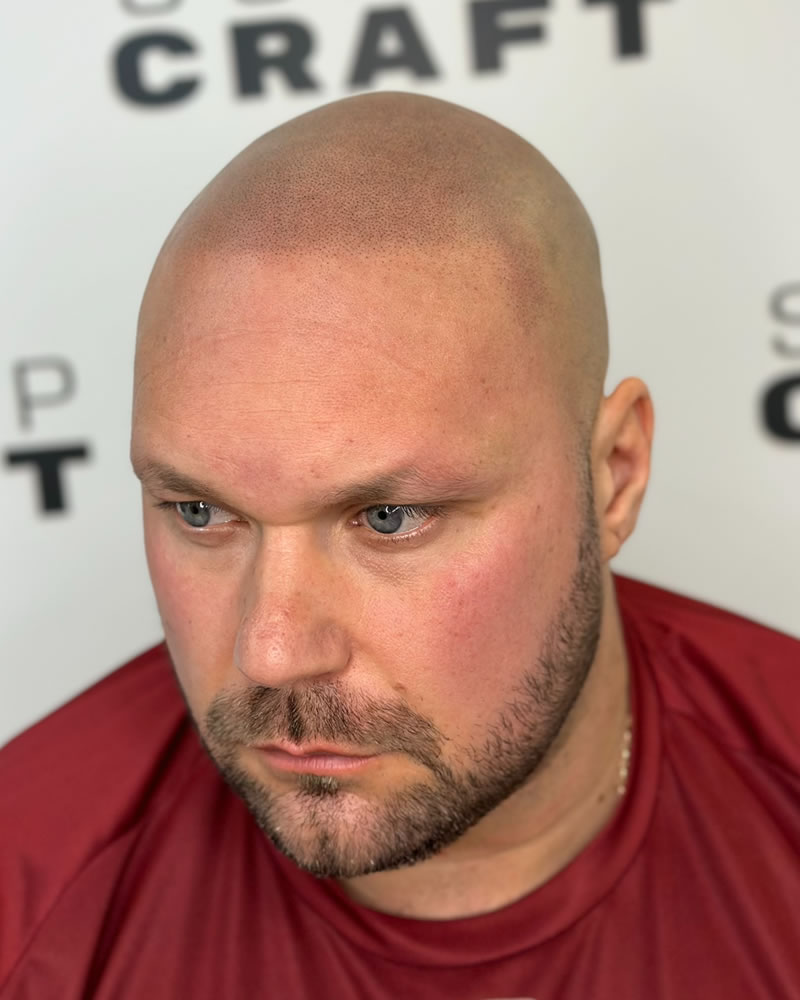 Mike Scalp Micropigmentation SMP Essex Mike Scalp Micropigmentation SMP Essex